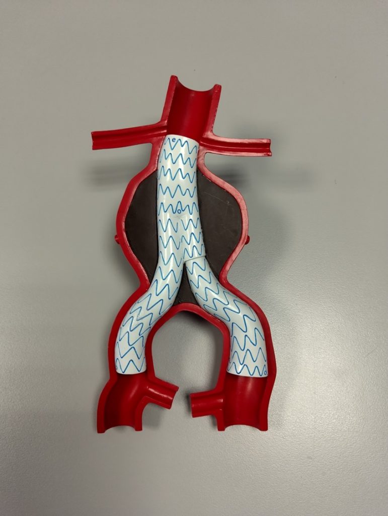 Aorte (en rouge) déformée par l’anévrysme (zone noire), ce dernier est traité par une endoprothèse (en blanc) positionnée à l’intérieur des vaisseaux pour rétablir son calibre